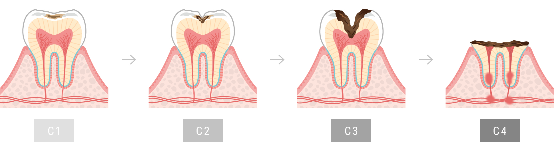 むし歯の進行度を表した図です。C1はエナメル質に達した虫歯、C2は象牙質まで進行した虫歯、C3は神経まで進行した虫歯、C4は歯の根っこのみが残った虫歯で、歯の冠部分がほとんど崩壊している状態です。