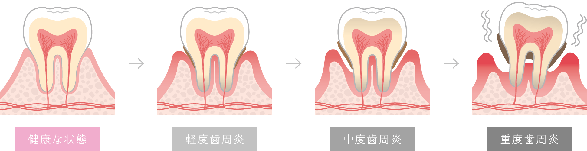 歯周炎の進行度を表した図です。健康な状態では歯肉はやや薄いピンク色をして引き締まっています。軽度歯周炎は歯茎が腫れて歯周ポケットが深くなります。中度歯周炎では歯ぐきの炎症が広がり、歯を支える歯槽骨が溶け、歯がぐらつくようになります。重度歯周炎では歯茎が大幅に下がり歯が大きくグラグラして膿や口臭が出ます。