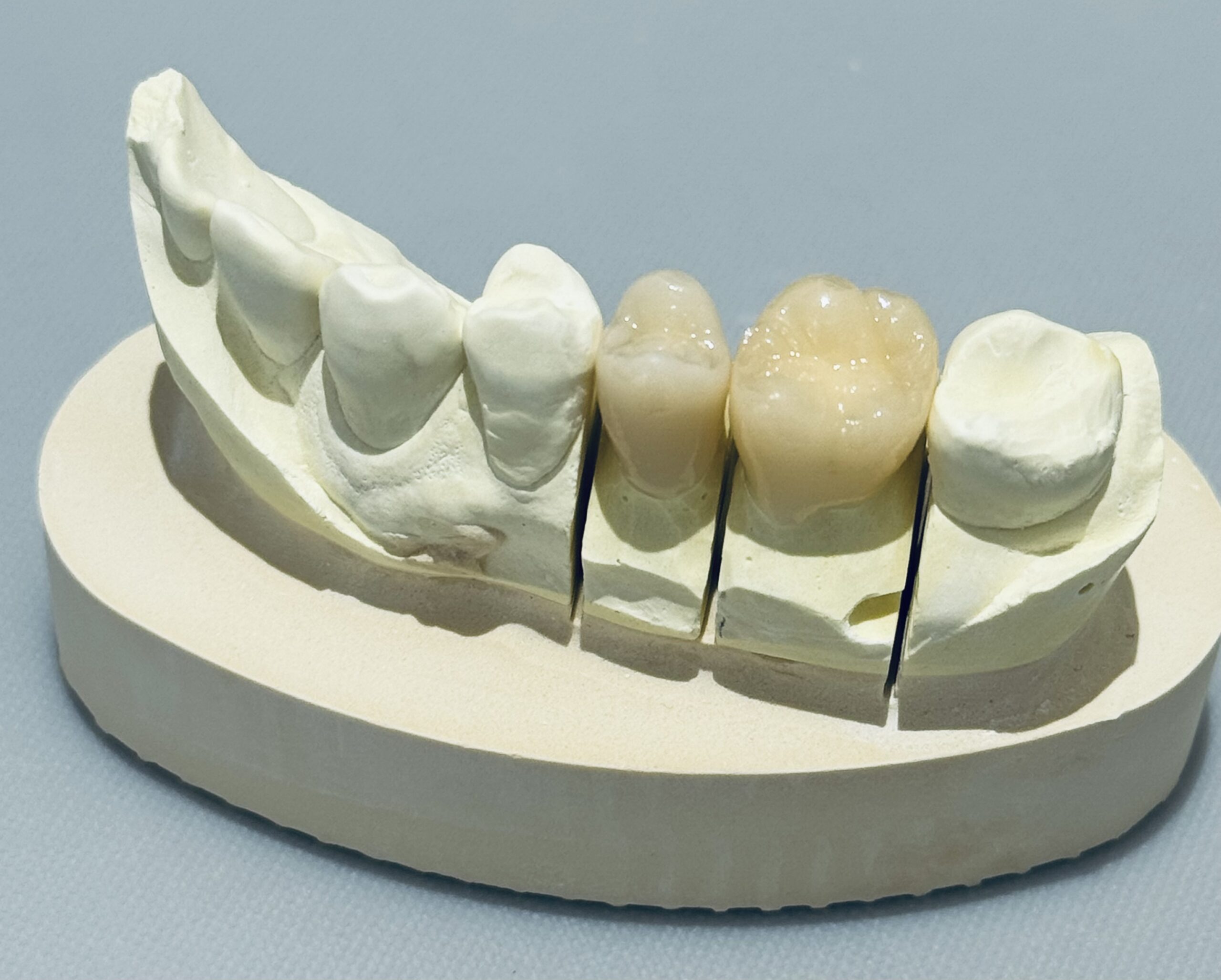 【2024年6月改定】保険で白い歯に！奥歯に白い歯を！CAD/CAM冠用材料（Ⅲ）の適応条件を詳しく解説