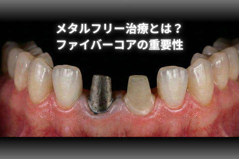 メタルフリー治療とは？見た目だけじゃない「ファイバーコア」の重要性